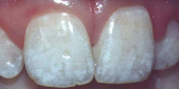 Flouride Spotted Teeth photo